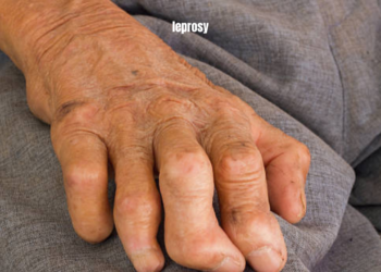 leprosy