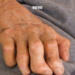 leprosy